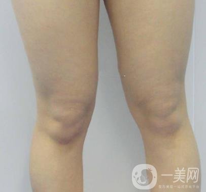 中南大學(xué)第一醫(yī)院整形美容科價格表*新發(fā)布,附全身吸脂*果分享