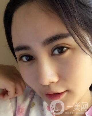 北京處整形外科價(jià)格(目)表2020一覽，附雙眼皮案例