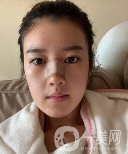 鹽城東方女子整形醫(yī)院價格表明細，附隆鼻案例