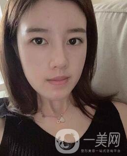 鹽城東方女子整形醫(yī)院價格表明細，附隆鼻案例