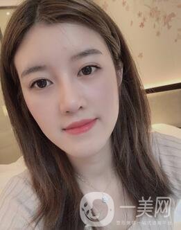 鹽城東方女子整形醫(yī)院價格表明細，附隆鼻案例