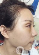 蘭大二院整形外科價格表2020，附雙眼皮整形日記