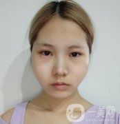 運城中心醫(yī)院整形外科價格表，附顴骨降低案例分享