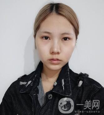 運(yùn)城中心醫(yī)院整形外科價(jià)格表，附顴骨降低案例分享