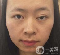 河南省立眼科醫(yī)院做上臉下垂怎么樣?價格表和真人果圖展示