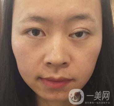 河南省立眼科醫(yī)院做上臉下垂怎么樣?價(jià)格表和真人*果圖展示