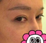 北京友誼醫(yī)院整形科祛眼袋果好不好？2020年價格價目收費曝光啦