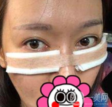 北京友誼醫(yī)院整形科祛眼袋*果好不好？2020年價(jià)格價(jià)目收費(fèi)曝光啦