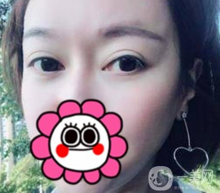 北京友誼醫(yī)院整形科祛眼袋*果好不好？2020年價(jià)格價(jià)目收費(fèi)曝光啦