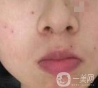 青醫(yī)附院激光去痣多少錢？案例及整形價(jià)格表分享
