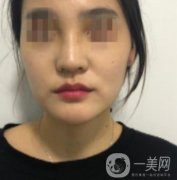 深圳人民醫(yī)院整形外科價(jià)目表，附隆鼻案例