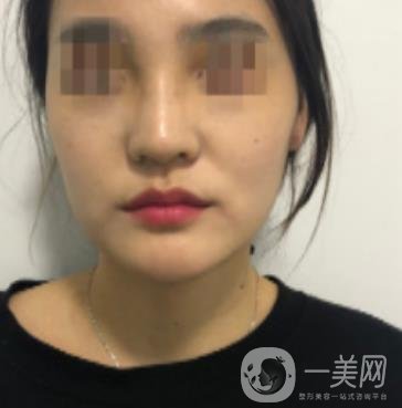 深圳人民醫(yī)院整形外科價(jià)目表，附隆鼻案例