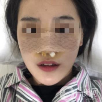 深圳人民醫(yī)院整形外科價(jià)目表，附隆鼻案例