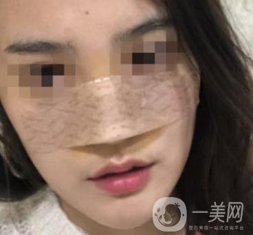 深圳人民醫(yī)院整形外科價(jià)目表，附隆鼻案例
