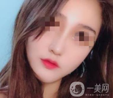 深圳人民醫(yī)院整形外科價(jià)目表，附隆鼻案例