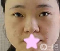 寶雞人民醫(yī)院美容科價格表及*前后恢復(fù)圖