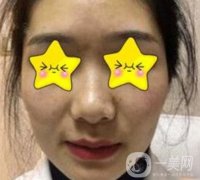 深圳北大醫(yī)院整形科價(jià)格表及自體脂肪填充面部果一覽