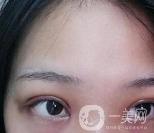 上海華美醫(yī)療美容醫(yī)院價格表，附雙眼皮修復(fù)案例