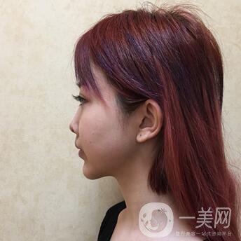 廣州曙光醫(yī)學(xué)美容醫(yī)院價格表及肋軟骨隆鼻案例分享