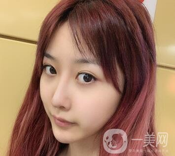 廣州曙光醫(yī)學(xué)美容醫(yī)院價格表及肋軟骨隆鼻案例分享
