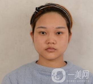 成都銅雀臺整形醫(yī)院隆鼻案例分享，附全新價格表