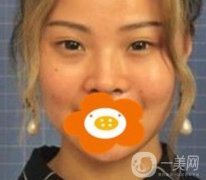 蚌埠美萊塢整形醫(yī)院玻尿酸隆鼻果如何？?jī)r(jià)格表2020年收費(fèi)公布