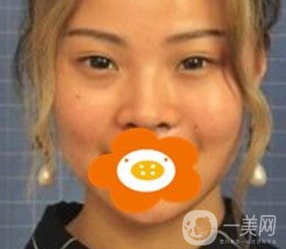 蚌埠美萊塢整形醫(yī)院玻尿酸隆鼻*果如何？價格表2020年收費公布