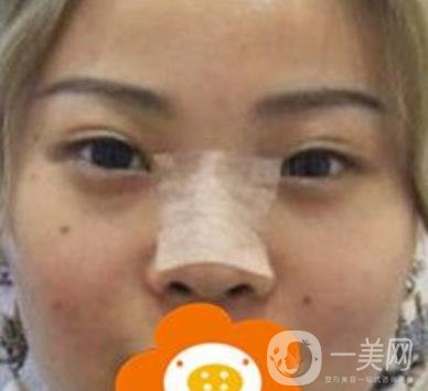 蚌埠美萊塢整形醫(yī)院玻尿酸隆鼻*果如何？價格表2020年收費公布