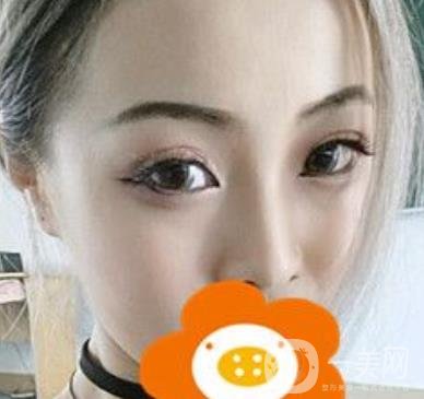 蚌埠美萊塢整形醫(yī)院玻尿酸隆鼻*果如何？價格表2020年收費公布