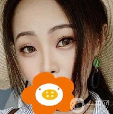 蚌埠美萊塢整形醫(yī)院玻尿酸隆鼻*果如何？價格表2020年收費公布
