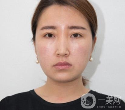 常州美貝爾整形美容醫(yī)院*注射多少錢？?jī)r(jià)格明細(xì)和*果圖展示