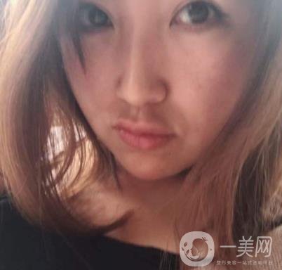 常州美貝爾整形美容醫(yī)院*注射多少錢？?jī)r(jià)格明細(xì)和*果圖展示