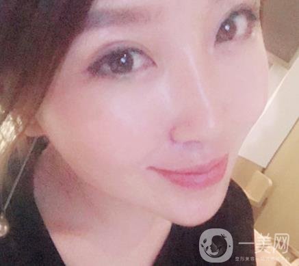 常州美貝爾整形美容醫(yī)院*注射多少錢？?jī)r(jià)格明細(xì)和*果圖展示