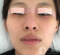 大連市中心醫(yī)院雙眼皮怎么樣？費(fèi)用是多少？真人恢復(fù)經(jīng)歷自述