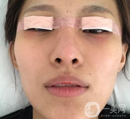 大連市中心醫(yī)院雙眼皮怎么樣？費用是多少？真人恢復(fù)經(jīng)歷自述