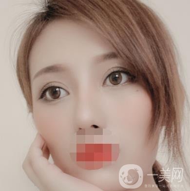 大連市中心醫(yī)院雙眼皮怎么樣？費用是多少？真人恢復(fù)經(jīng)歷自述
