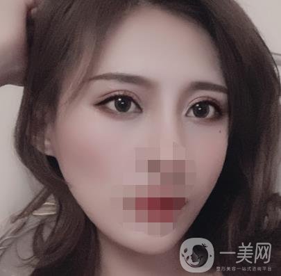 大連市中心醫(yī)院雙眼皮怎么樣？費用是多少？真人恢復(fù)經(jīng)歷自述