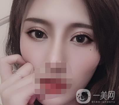 大連市中心醫(yī)院雙眼皮怎么樣？費用是多少？真人恢復(fù)經(jīng)歷自述