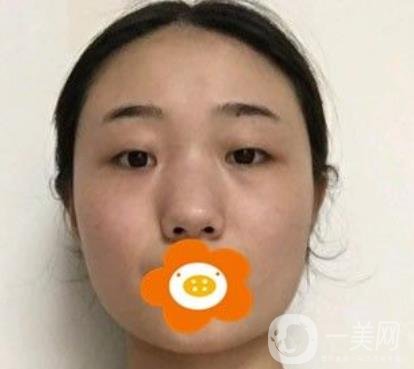 南京美貝爾整形醫(yī)院做*好不好？價格表費用明細(xì)和*果圖參考