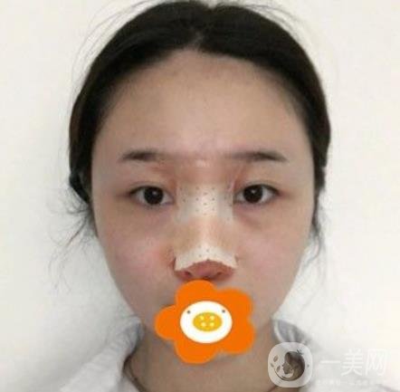 南京美貝爾整形醫(yī)院做*好不好？價格表費用明細(xì)和*果圖參考