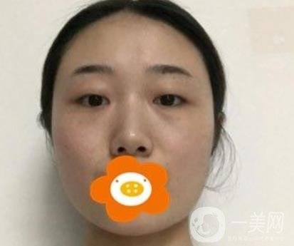 南京美貝爾整形醫(yī)院做*好不好？價格表費用明細(xì)和*果圖參考