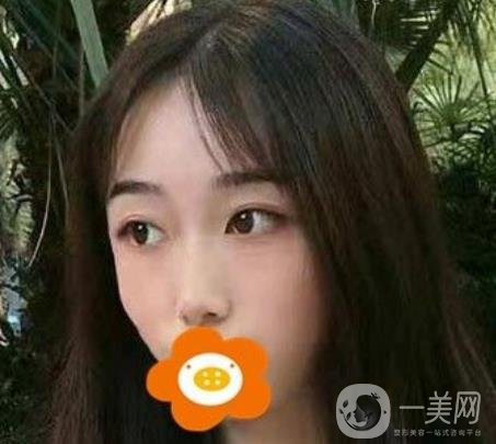 南京美貝爾整形醫(yī)院做*好不好？價格表費用明細(xì)和*果圖參考