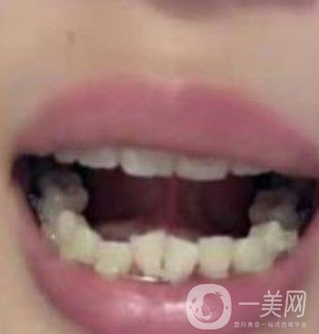 廣東省口腔醫(yī)院正畸價(jià)格表及案例恢復(fù)過(guò)程分享