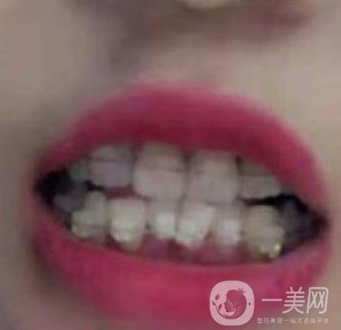 廣東省口腔醫(yī)院正畸價(jià)格表及案例恢復(fù)過(guò)程分享