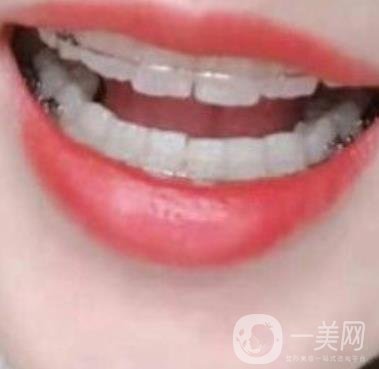 廣東省口腔醫(yī)院正畸價(jià)格表及案例恢復(fù)過(guò)程分享