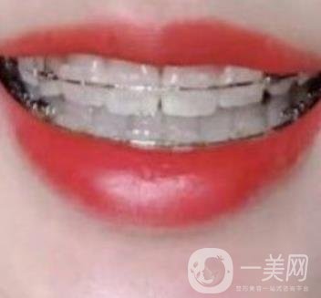 廣東省口腔醫(yī)院正畸價(jià)格表及案例恢復(fù)過(guò)程分享
