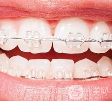 廣東省口腔醫(yī)院正畸價(jià)格表及案例恢復(fù)過(guò)程分享