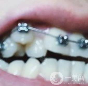 貴州口腔醫(yī)院正畸醫(yī)生信息介紹?內含牙齒美容項目價格表及案例