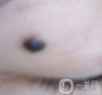 青醫(yī)附院王彥進(jìn)去痣怎么樣？?jī)r(jià)格表及*果展示
