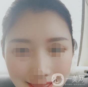 青醫(yī)附院王彥進(jìn)去痣怎么樣？?jī)r(jià)格表及*果展示